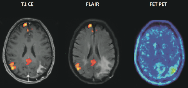 glioma